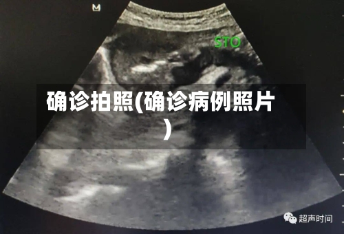 确诊拍照(确诊病例照片)