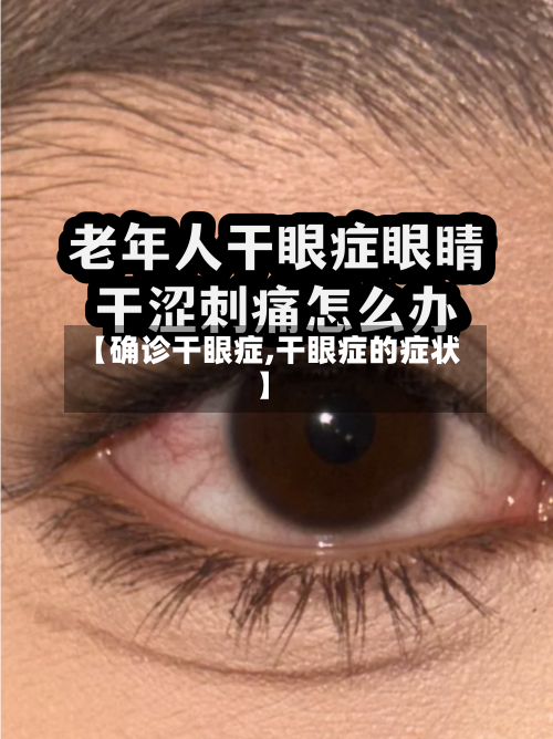 【确诊干眼症,干眼症的症状】-第3张图片