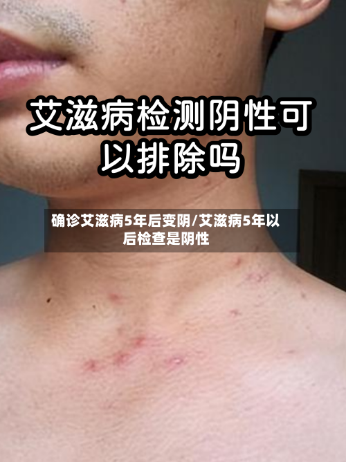 确诊艾滋病5年后变阴/艾滋病5年以后检查是阴性