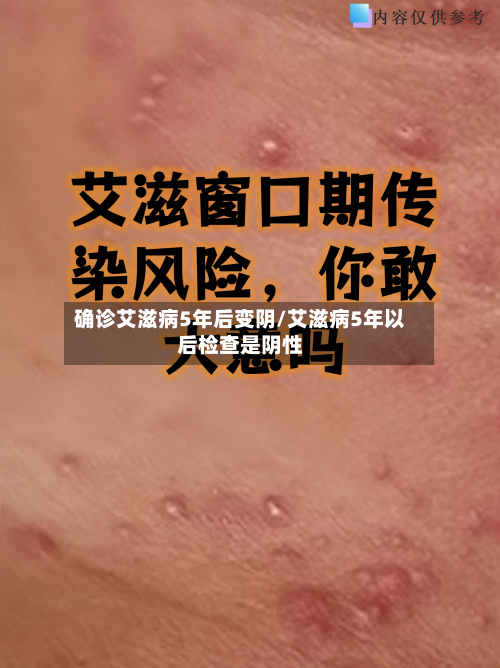 确诊艾滋病5年后变阴/艾滋病5年以后检查是阴性-第3张图片