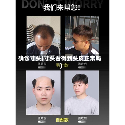 确诊寸头(寸头看得到头皮正常吗)