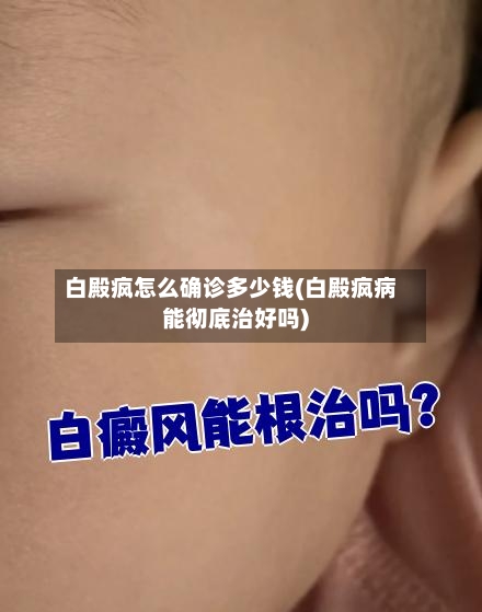 白殿疯怎么确诊多少钱(白殿疯病能彻底治好吗)