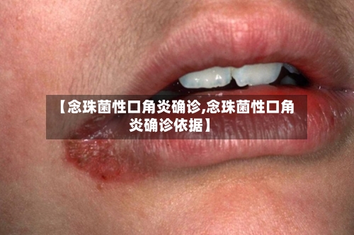 【念珠菌性口角炎确诊,念珠菌性口角炎确诊依据】